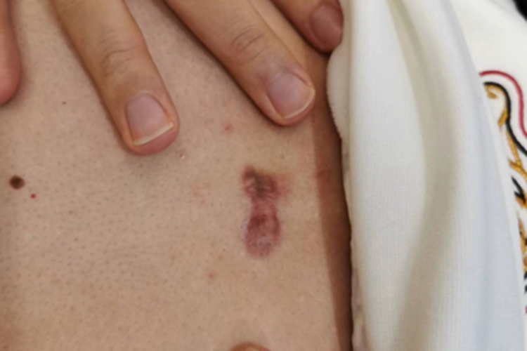 瘢痕疙瘩腹部有一块疙瘩图 瘢痕疙瘩腹部有一块疙瘩图