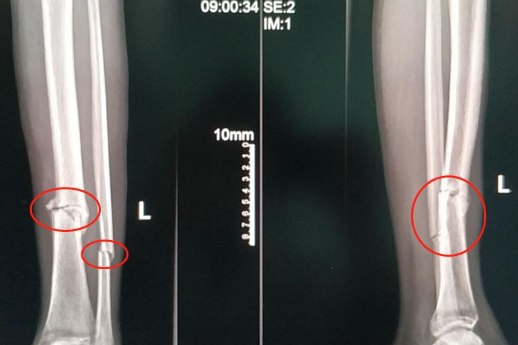 胫腓骨骨折长骨痂图 胫腓骨骨折长骨痂图