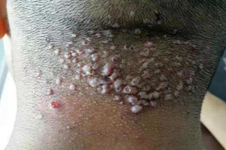 毛囊炎颈部大疙瘩密集图 毛囊炎颈部大疙瘩密集图