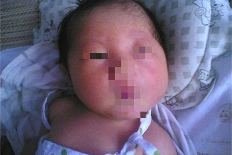 新生儿水肿面部水肿图 新生儿水肿面部水肿图
