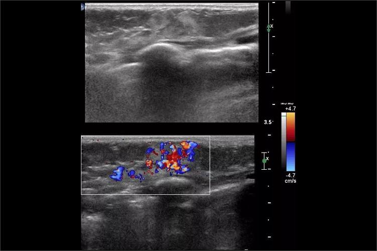 血管脂肪瘤超声图