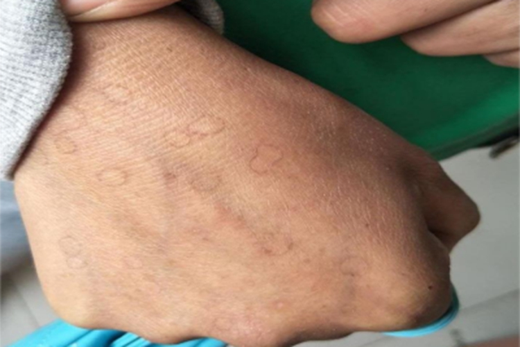 汗孔角化症长斑图