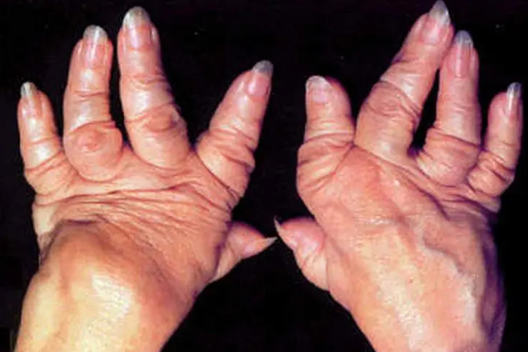 类风湿性关节炎手部肿胀畸形图