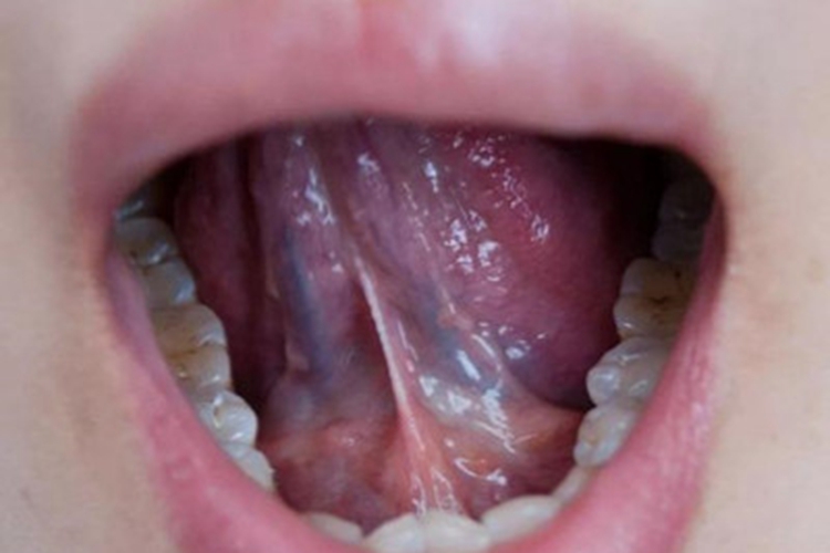 口腔尖锐湿疣肉球图 口腔尖锐湿疣肉球图