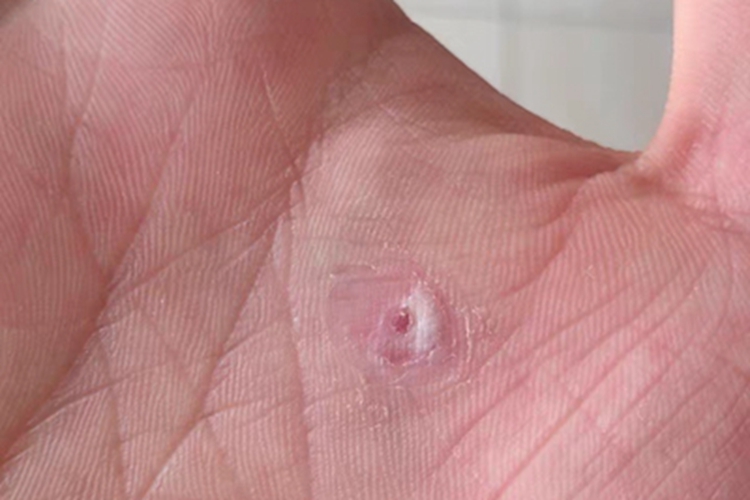 寻常疣手掌白斑图 寻常疣手掌白斑图