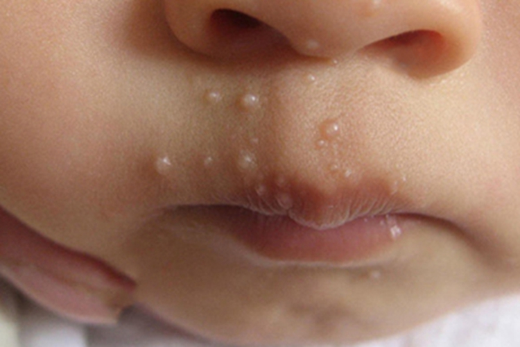 传染性软疣唇周症状图