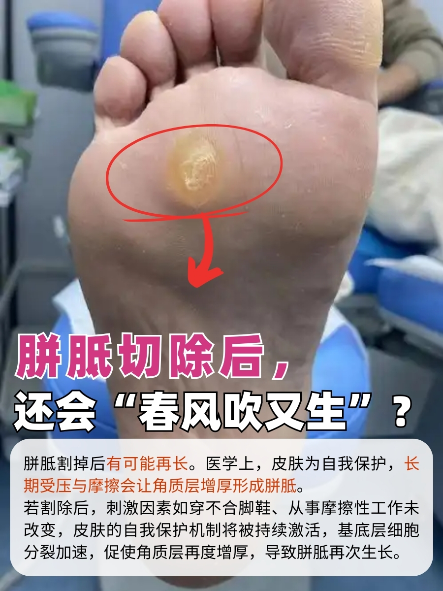 胼胝切除后,还会“春风吹又生”?