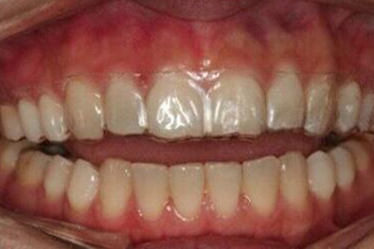 透明压膜保持器图