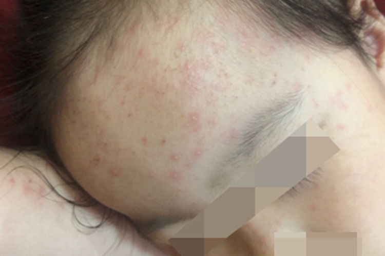 红痱额头上很多红疙瘩图