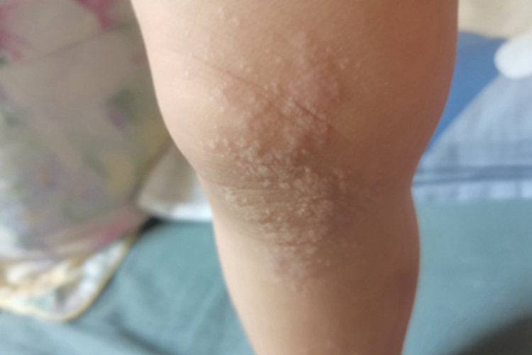 荨麻疹腿小疙瘩图
