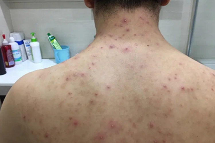 成人脂溢性皮炎背部疙瘩图 成人脂溢性皮炎背部疙瘩图