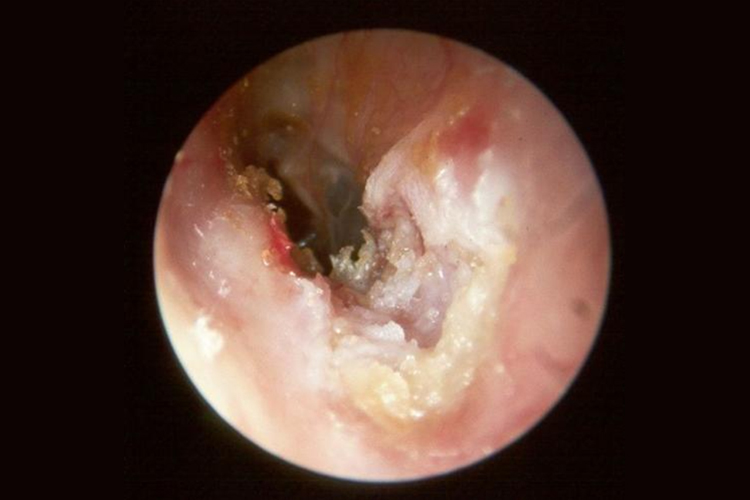 外耳道胆脂瘤图 外耳道胆脂瘤图