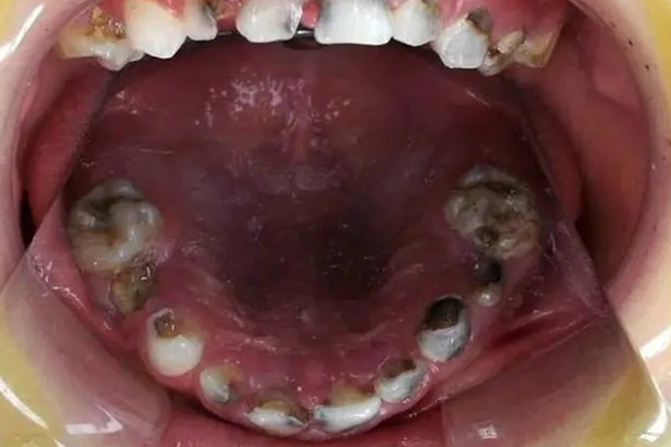 小孩不刷牙牙齿坏掉深龋图