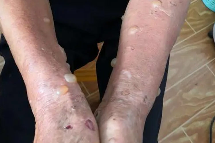 四肢天疱疮早期皮损图