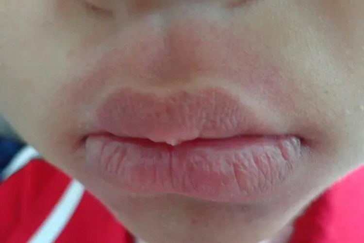 吃巴旦木过敏口周红斑唇肿图 吃巴旦木过敏口周红斑唇肿图