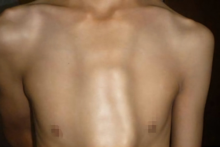 不对称性鸡胸 不对称性鸡胸