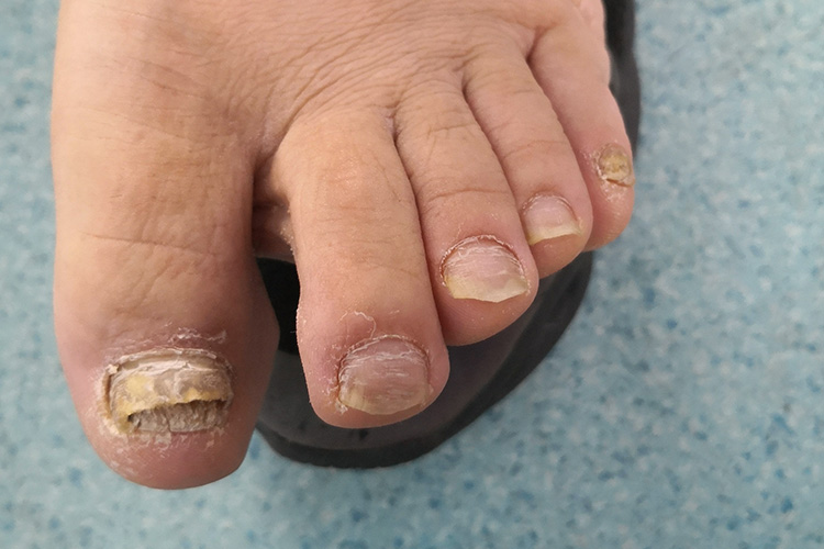 甲部增厚残缺图