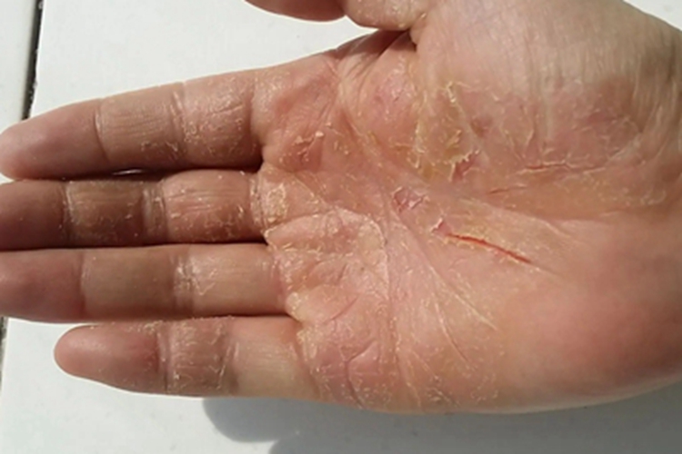 维生素A过多症手掌裂纹图