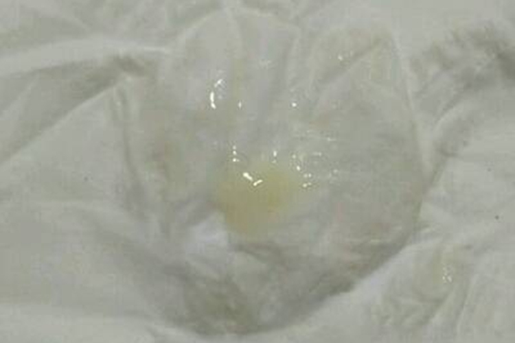 滴虫性尿道炎分泌物图 滴虫性尿道炎分泌物图