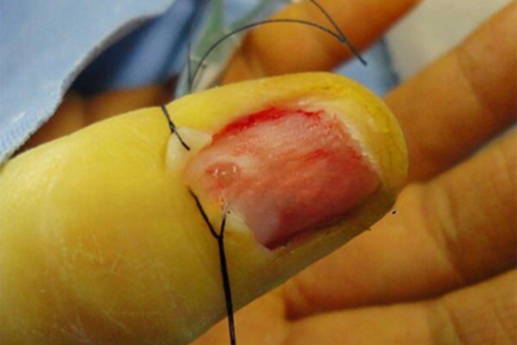 血管球瘤指甲症状图 血管球瘤指甲症状图