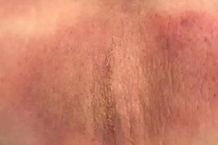 急性放射性皮炎腋窝红肿图