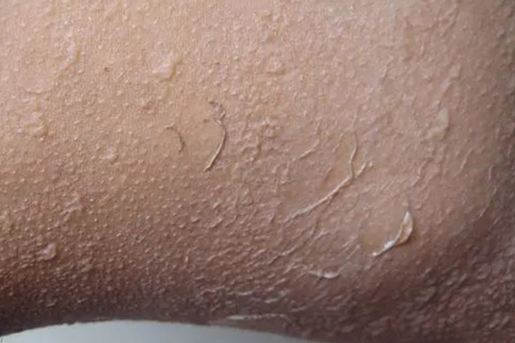 皮肤易擦除图 皮肤易擦除图