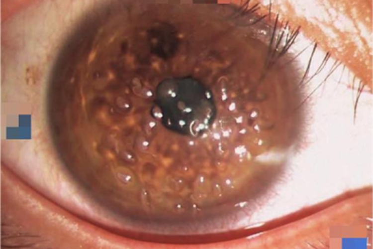 丝状角膜病变眼球小疙瘩图