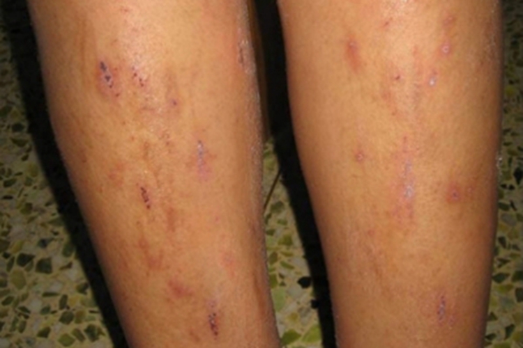 瘙痒症小腿红斑图