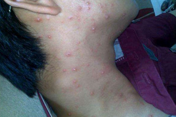 自身敏感性皮炎颈部丘疹图