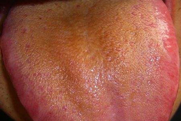 肝胃郁热型慢性胃炎舌苔图 肝胃郁热型慢性胃炎舌苔图