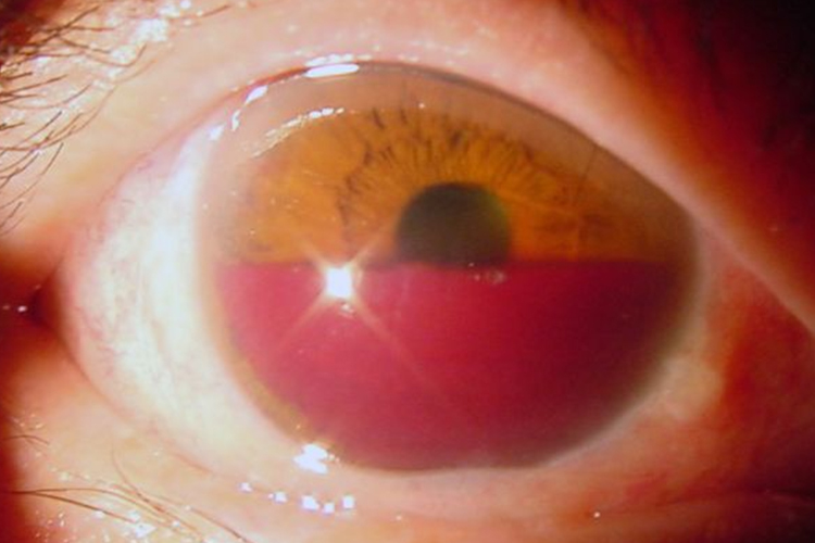 继发性青光眼图