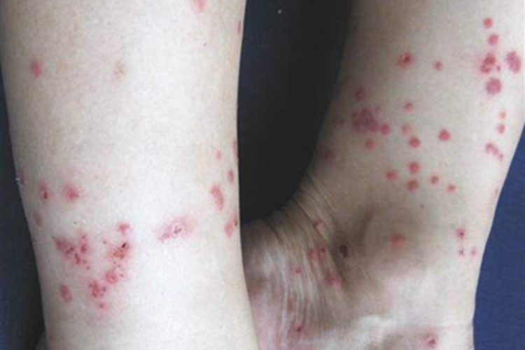血吸虫病小红疙瘩图 血吸虫病小红疙瘩图