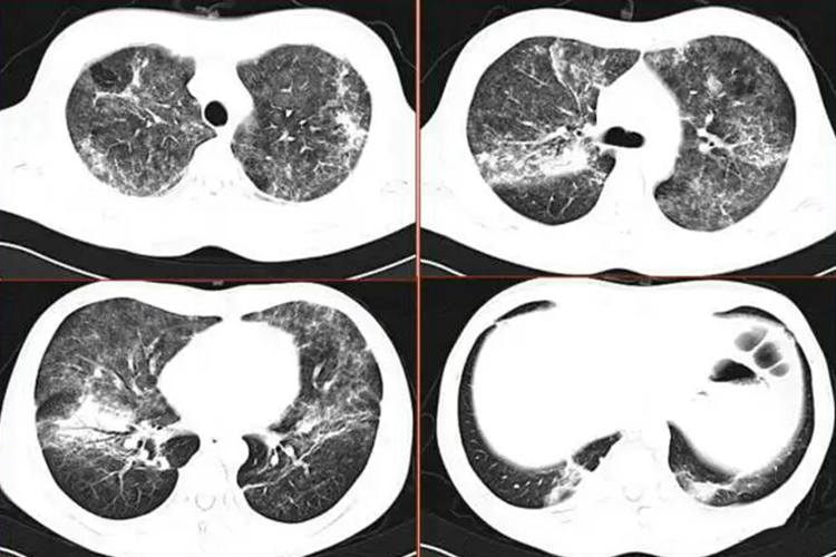 肺隐球菌病CT图 肺隐球菌病CT图