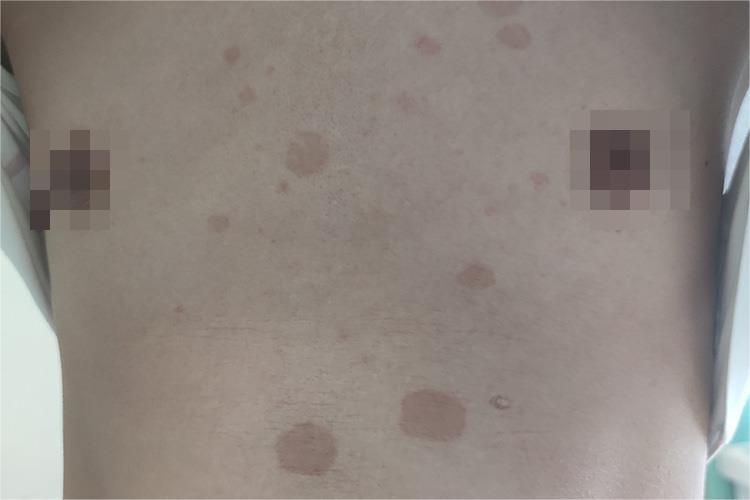 花斑癣圆形斑疹图