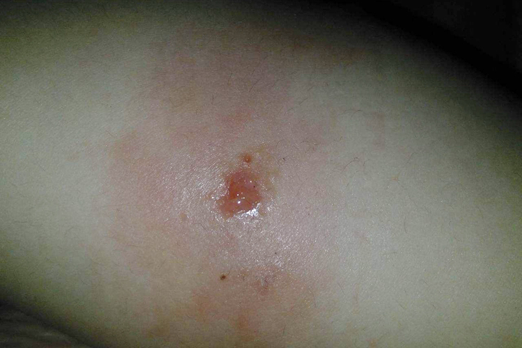 疱疹破了图片大全