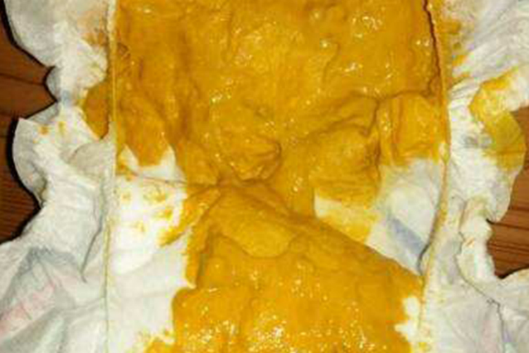 人乳喂养儿粪便图