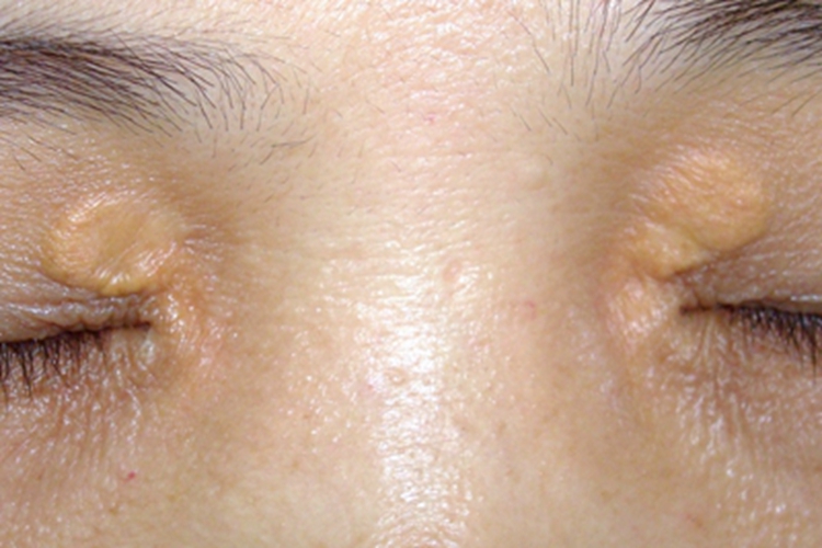 睑黄瘤症状图 睑黄瘤症状图