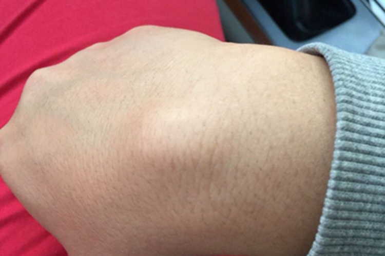 皮肤黏液瘤手腕肿块图