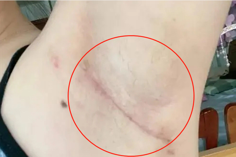 副乳切除后恢复图