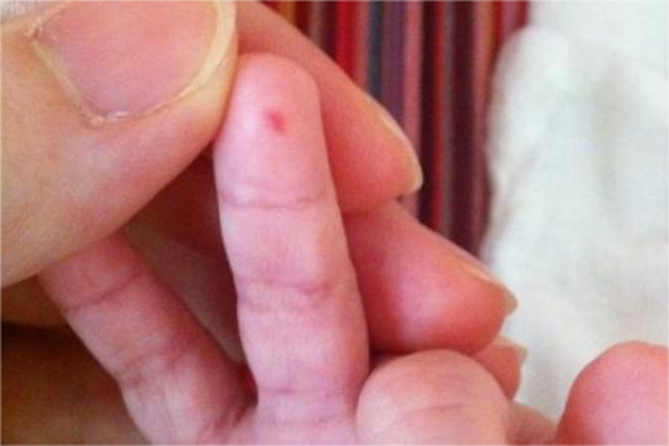 手指头上虫咬皮炎皮损图