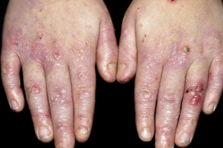 大疱性表皮松解症手背小疙瘩图