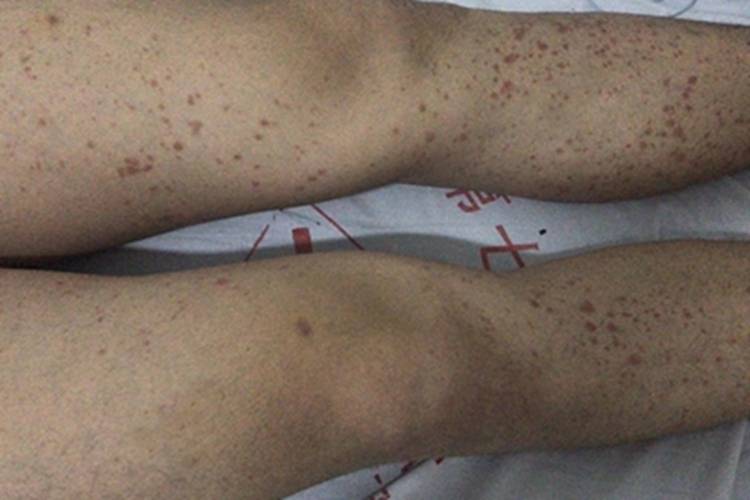 湿疹样紫癜腿红斑图 湿疹样紫癜腿红斑图