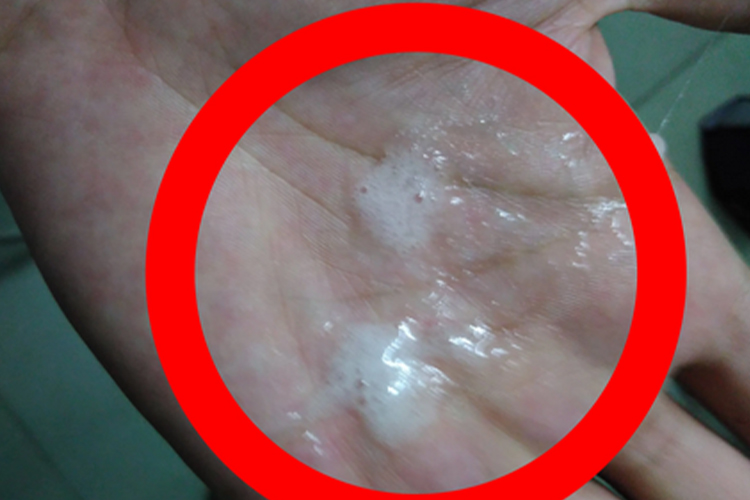 鼻息肉黏脓性分泌物图