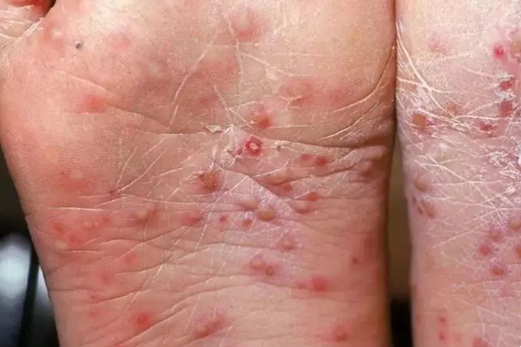 手足口病结痂图