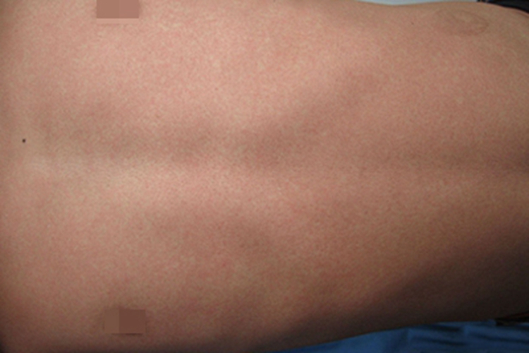 获得性风疹出疹期胸部症状图 获得性风疹出疹期胸部症状图