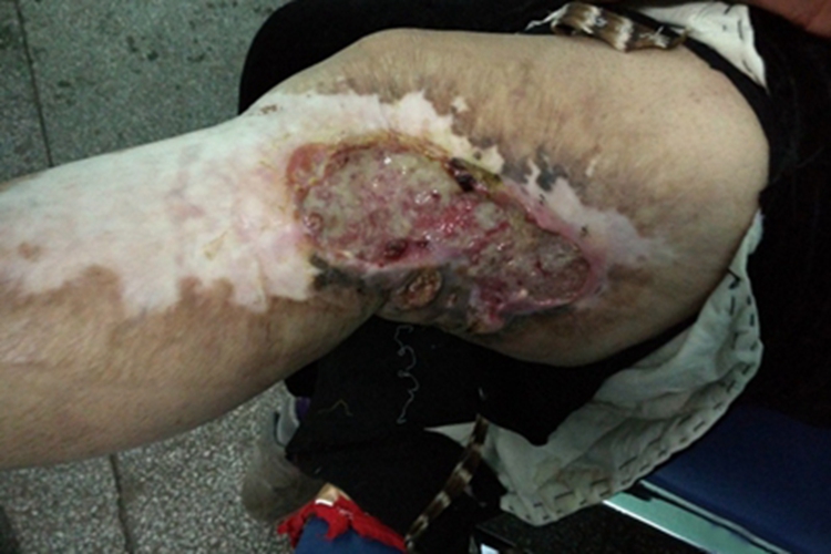 Ⅲ度烧伤化脓图