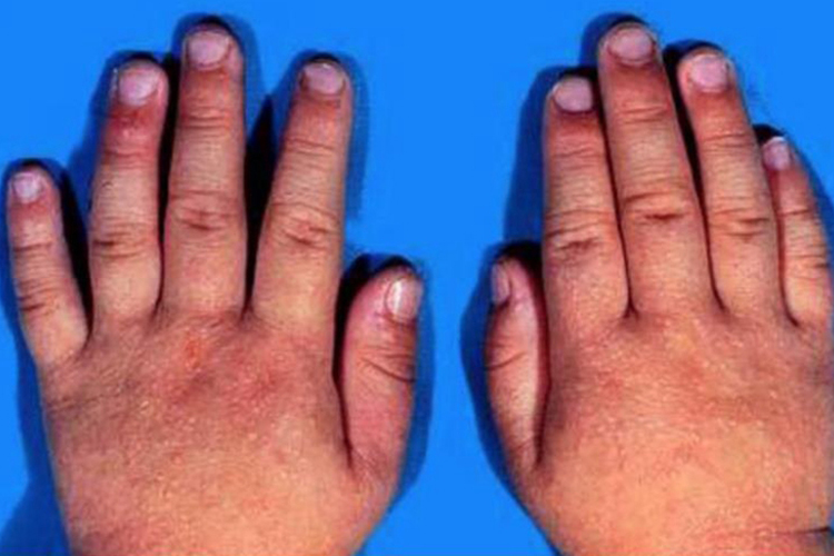 手背沙土皮炎图