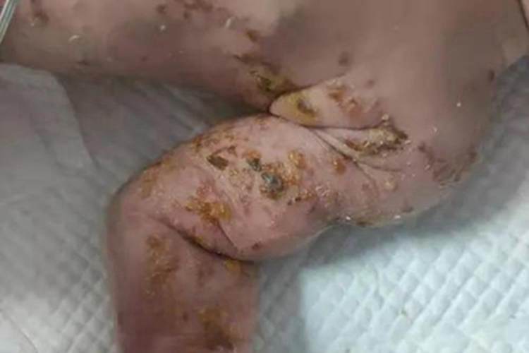 色素失调症胳膊症状图