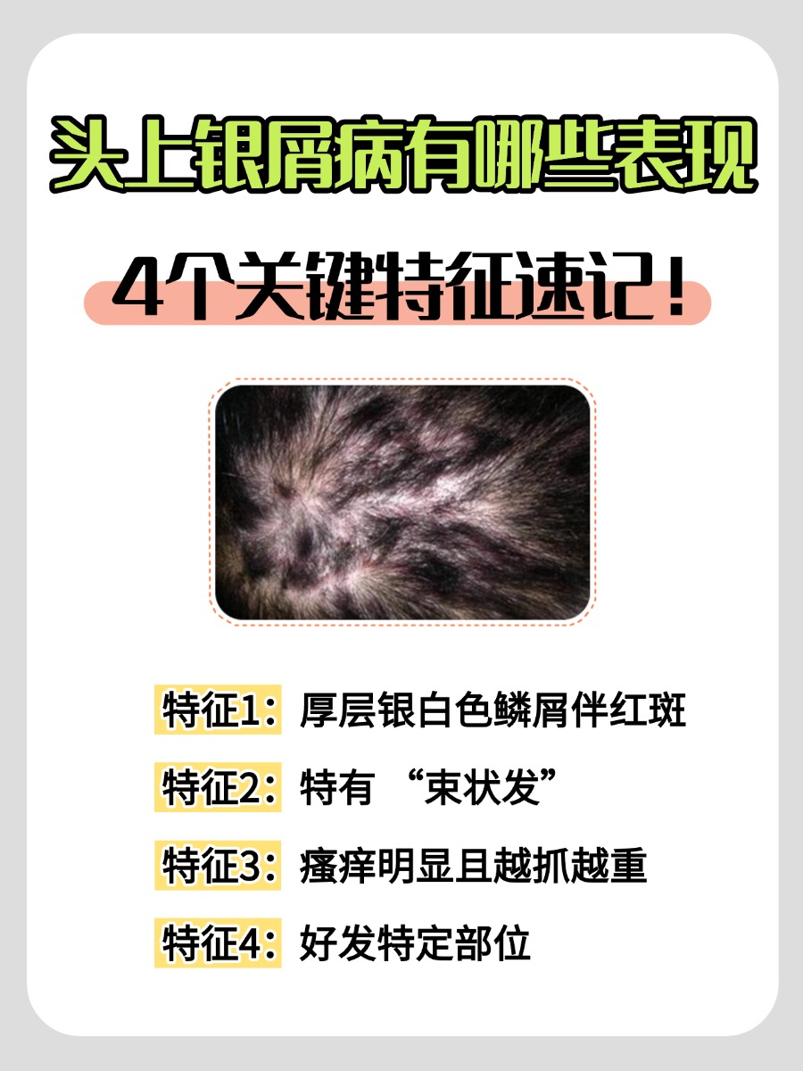 头上银屑病有哪些表现，4个关键特征速记！