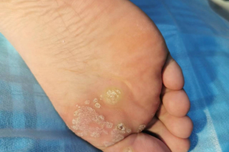 寻常疣脚底脱屑图